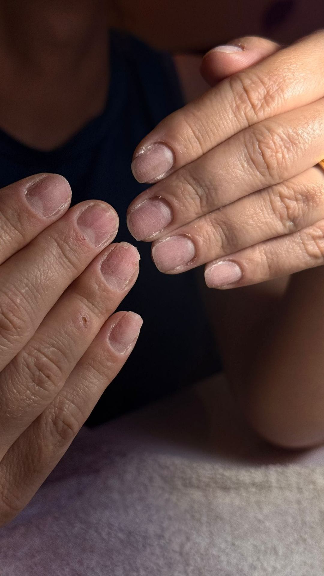 Unhas antes do procedimento
